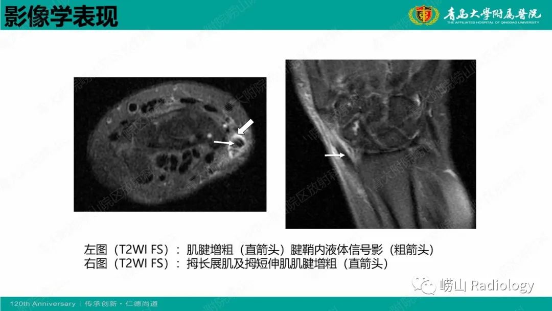 影像PPT - 【病例】桡骨茎突狭窄性腱鞘炎1例MR-17