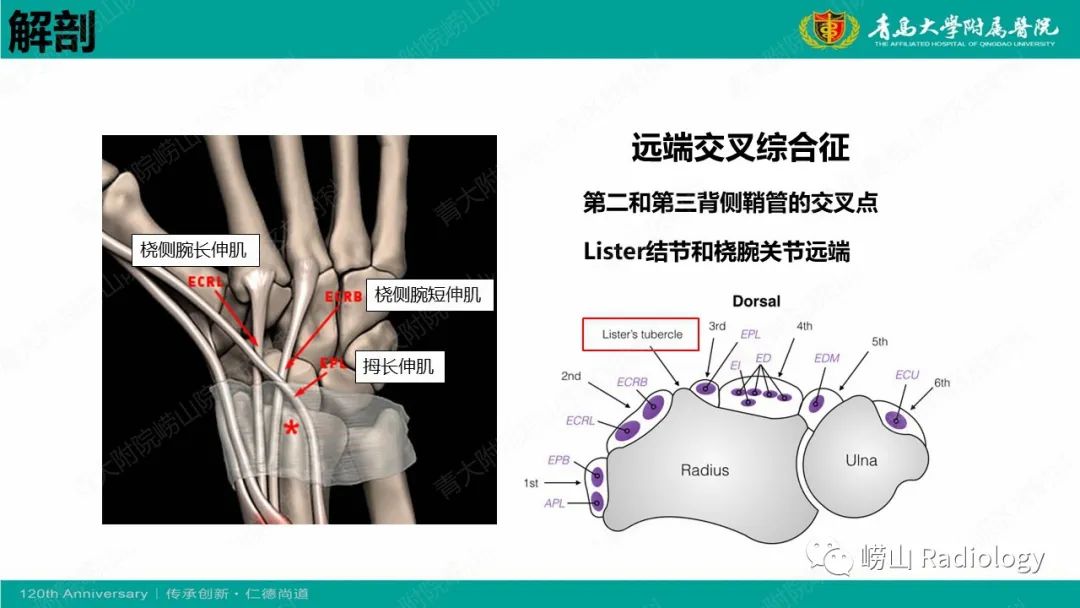 影像PPT - 【病例】桡骨茎突狭窄性腱鞘炎1例MR-23
