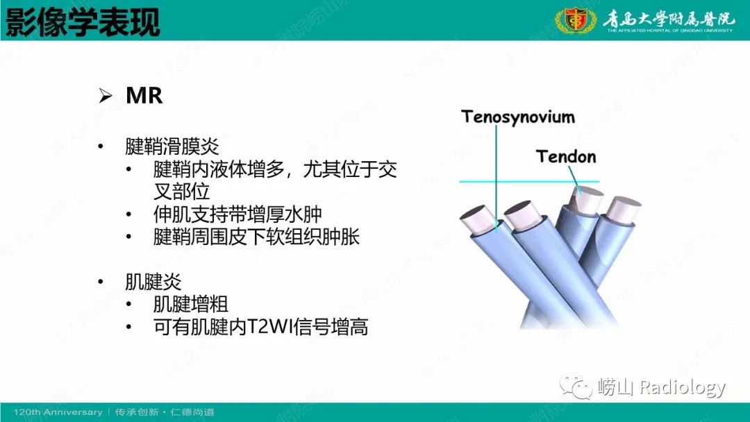 影像PPT - 【病例】桡骨茎突狭窄性腱鞘炎1例MR-24