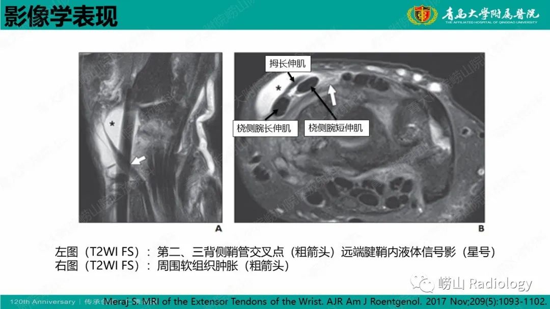 影像PPT - 【病例】桡骨茎突狭窄性腱鞘炎1例MR-25