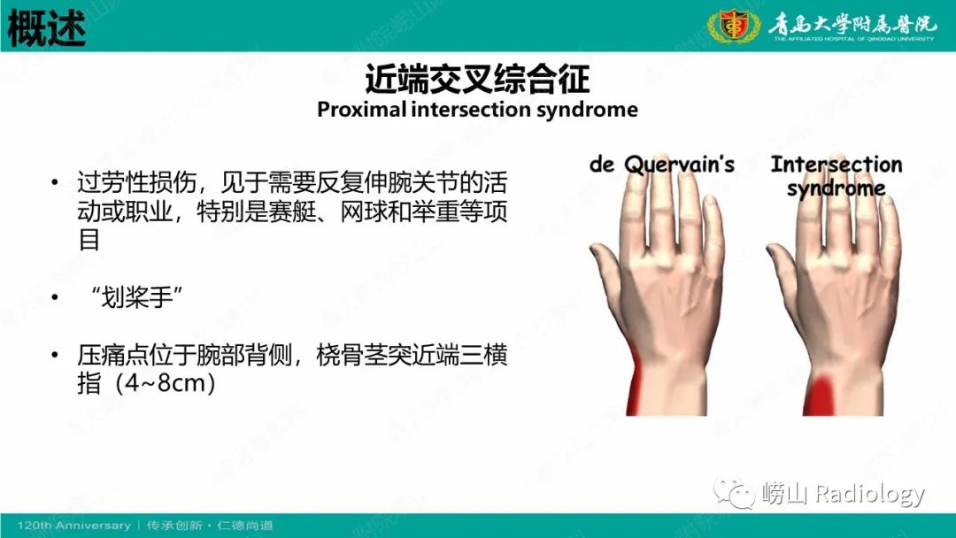 影像PPT - 【病例】桡骨茎突狭窄性腱鞘炎1例MR-26