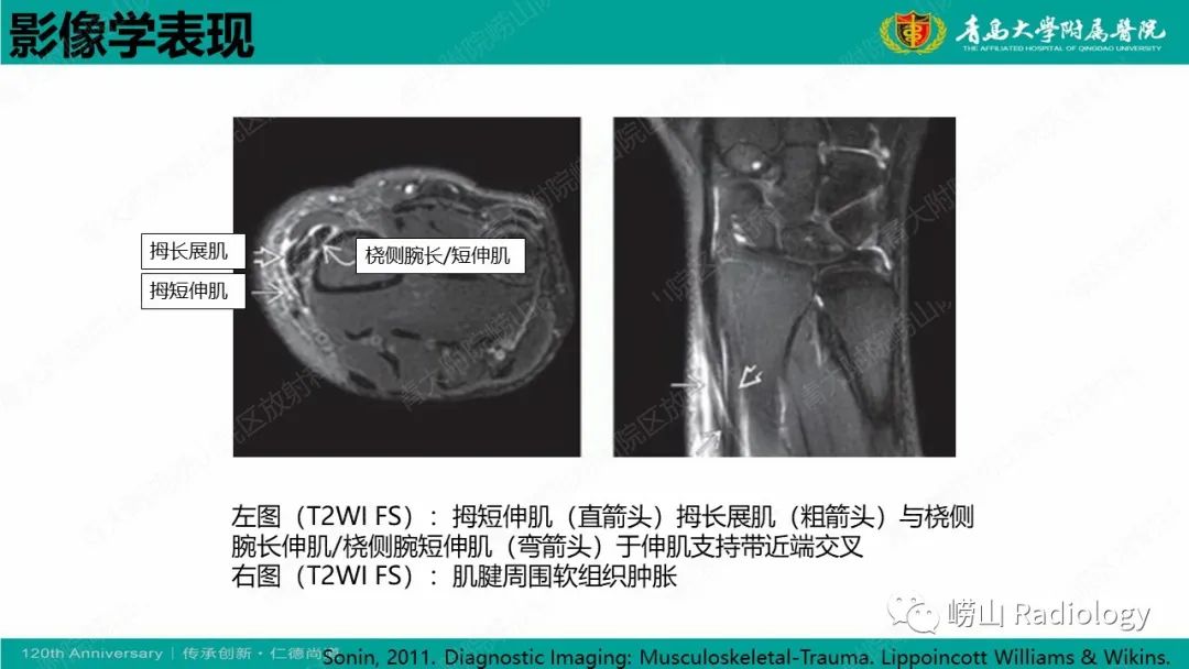影像PPT - 【病例】桡骨茎突狭窄性腱鞘炎1例MR-29