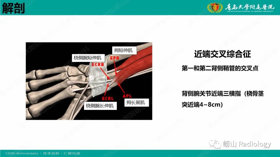 影像PPT - 【病例】桡骨茎突狭窄性腱鞘炎1例MR-28