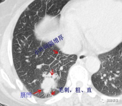 影像PPT - 【病例】从肺腺癌的随访,看肿瘤的影像征象-4 影像PPT - 【病例】从肺腺癌的随访,看肿瘤的影像征象-4