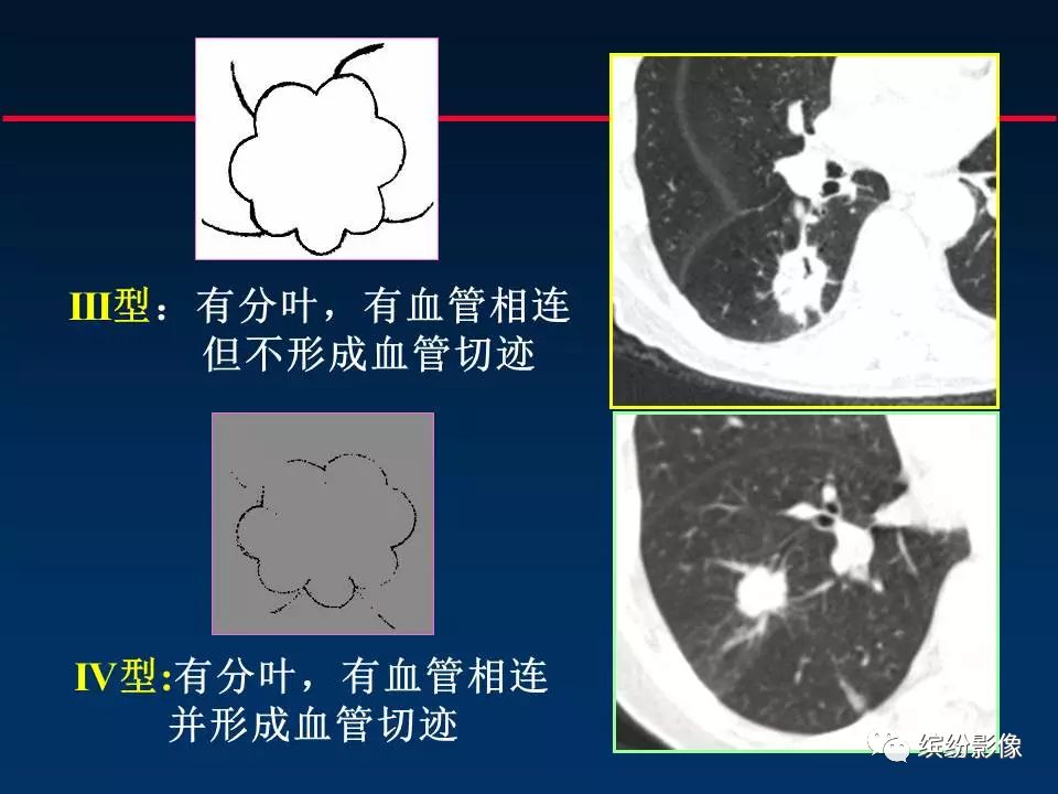 影像PPT - 【病例】从肺腺癌的随访,看肿瘤的影像征象-9 影像PPT - 【病例】从肺腺癌的随访,看肿瘤的影像征象-9
