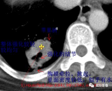 影像PPT - 【病例】从肺腺癌的随访,看肿瘤的影像征象-6 影像PPT - 【病例】从肺腺癌的随访,看肿瘤的影像征象-6