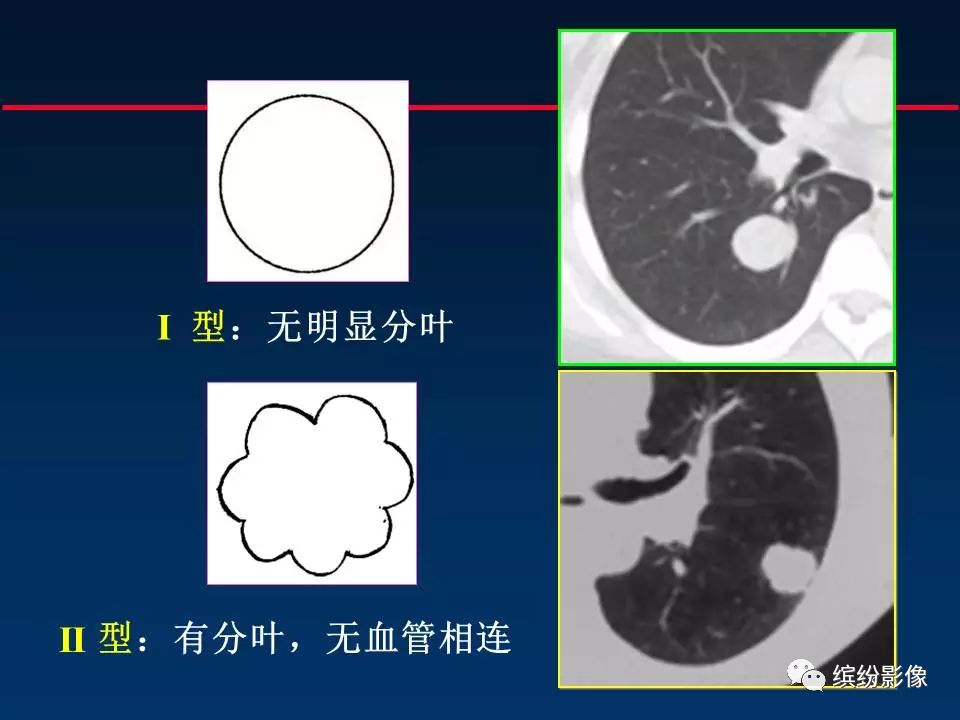 影像PPT - 【病例】从肺腺癌的随访,看肿瘤的影像征象-8 影像PPT - 【病例】从肺腺癌的随访,看肿瘤的影像征象-8