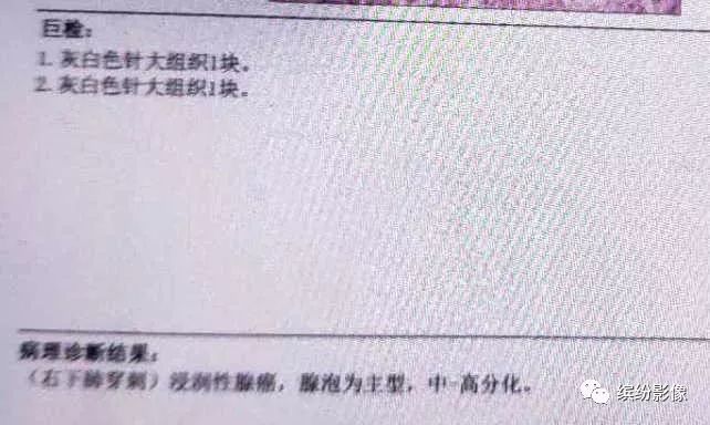 影像PPT - 【病例】从肺腺癌的随访,看肿瘤的影像征象-10 影像PPT - 【病例】从肺腺癌的随访,看肿瘤的影像征象-10