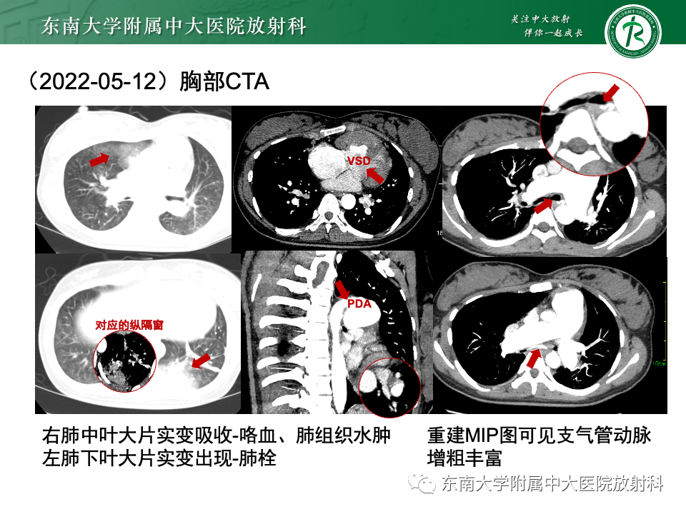 影像PPT - 【PPT】主动脉弓离断-6 影像PPT - 【PPT】主动脉弓离断-6