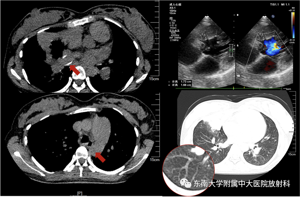 影像PPT - 【PPT】主动脉弓离断-2 影像PPT - 【PPT】主动脉弓离断-2