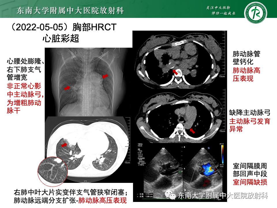 影像PPT - 【PPT】主动脉弓离断-5 影像PPT - 【PPT】主动脉弓离断-5