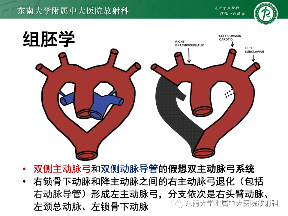 影像PPT - 【PPT】主动脉弓离断-11 影像PPT - 【PPT】主动脉弓离断-11