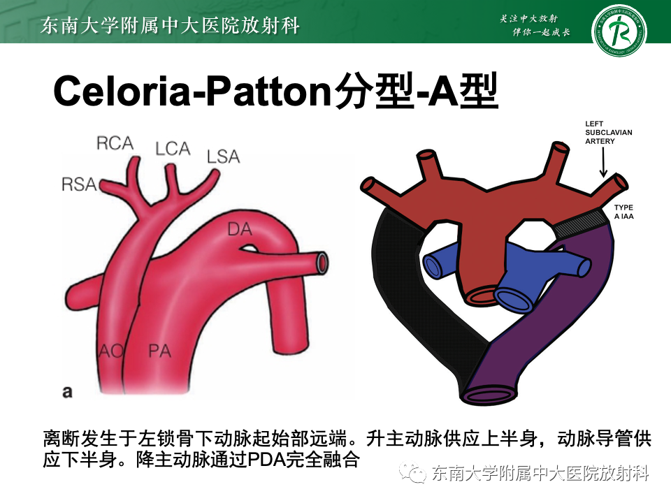 影像PPT - 【PPT】主动脉弓离断-15 影像PPT - 【PPT】主动脉弓离断-15