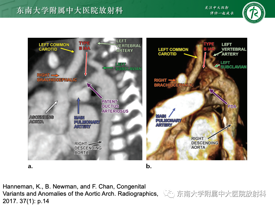 影像PPT - 【PPT】主动脉弓离断-20 影像PPT - 【PPT】主动脉弓离断-20
