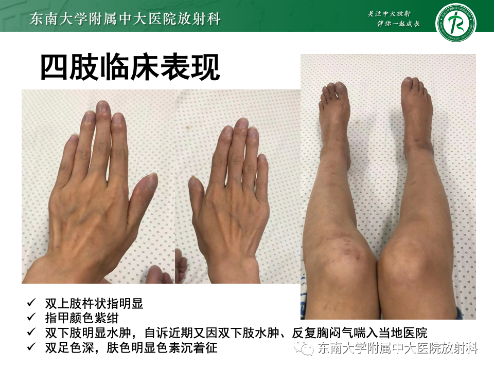 影像PPT - 【PPT】主动脉弓离断-26 影像PPT - 【PPT】主动脉弓离断-26