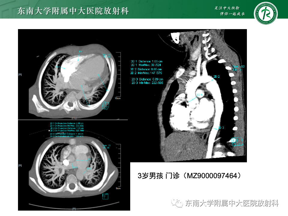 影像PPT - 【PPT】主动脉弓离断-35 影像PPT - 【PPT】主动脉弓离断-35