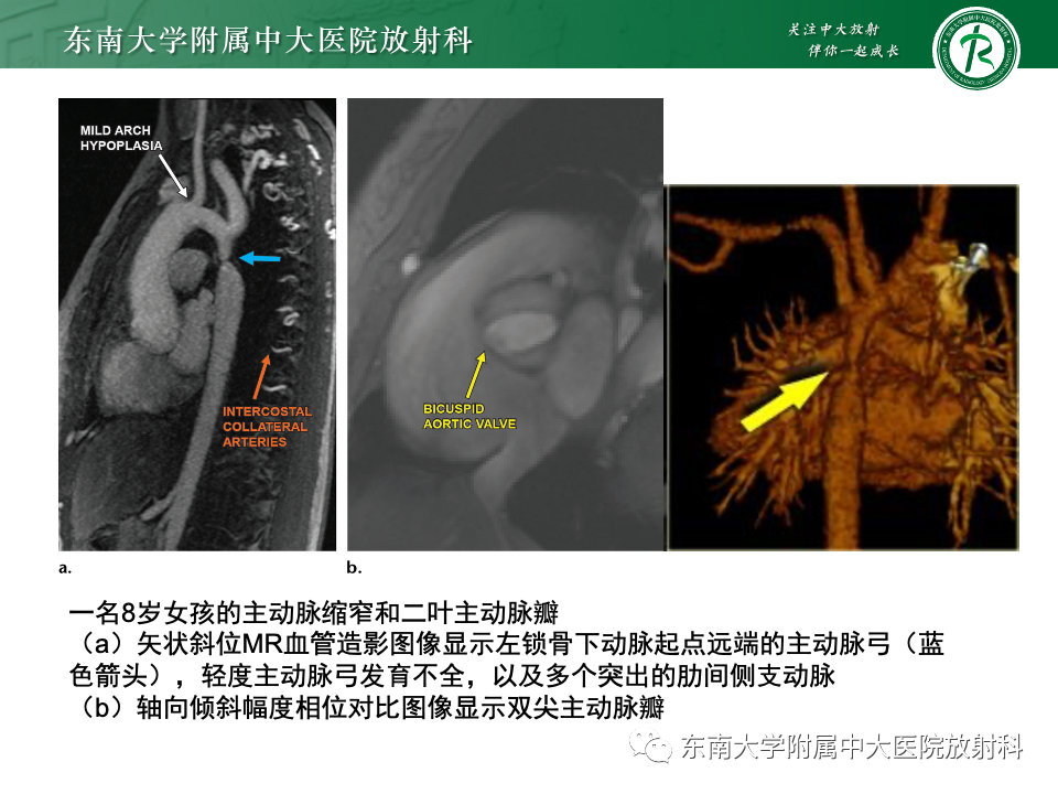 影像PPT - 【PPT】主动脉弓离断-36 影像PPT - 【PPT】主动脉弓离断-36