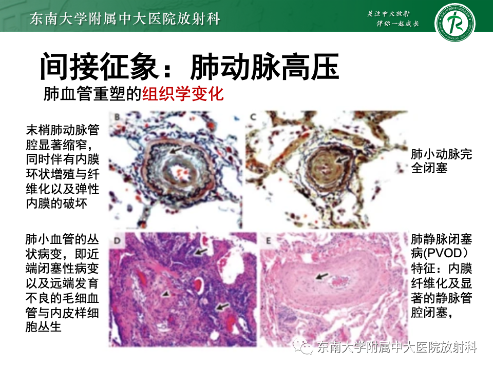 影像PPT - 【PPT】主动脉弓离断-2 影像PPT - 【PPT】主动脉弓离断-2
