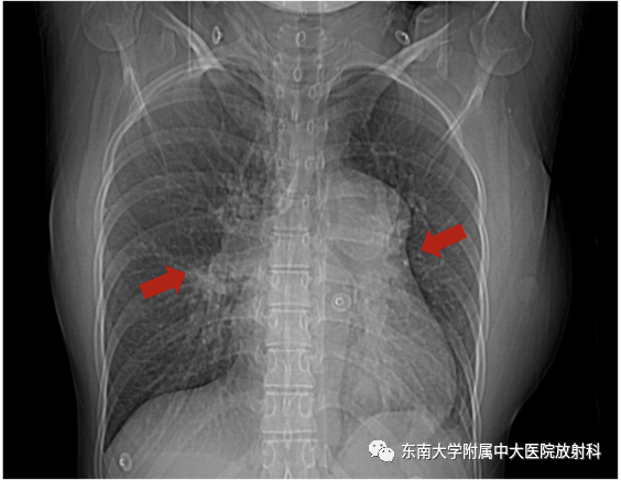影像PPT - 【PPT】主动脉弓离断-1 影像PPT - 【PPT】主动脉弓离断-1