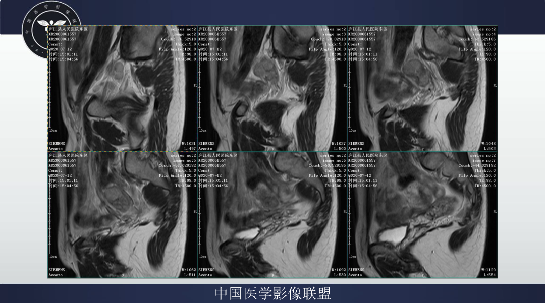影像PPT - 【病例】卵巢透明细胞癌1例MR影像表现-7