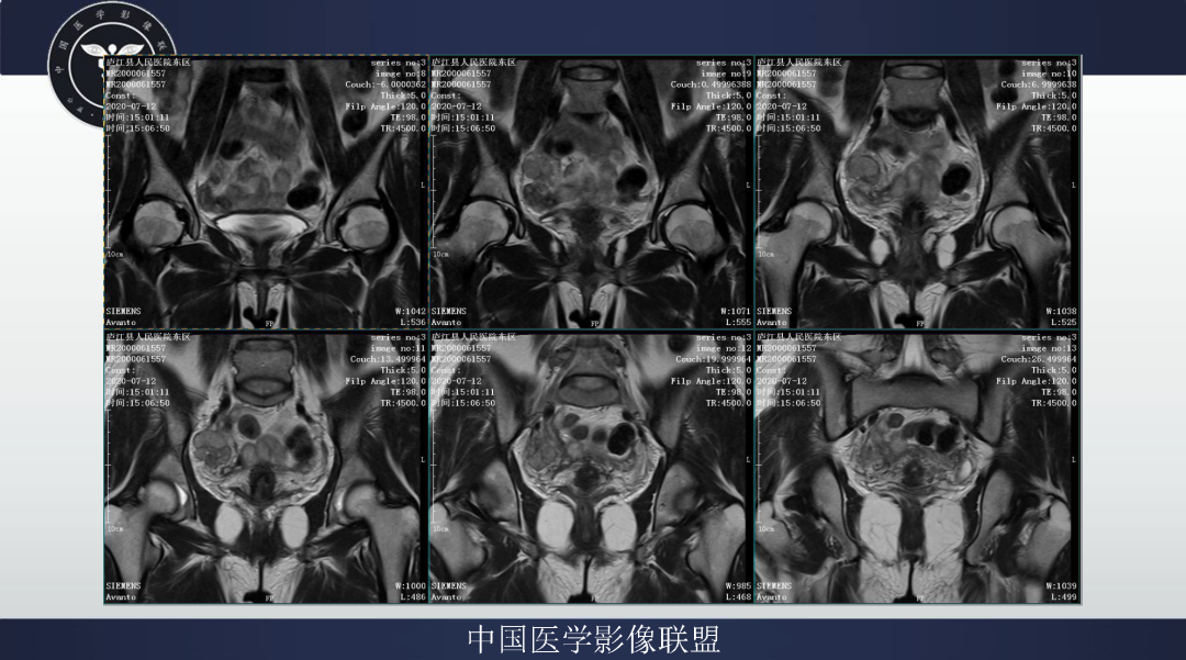 影像PPT - 【病例】卵巢透明细胞癌1例MR影像表现-6