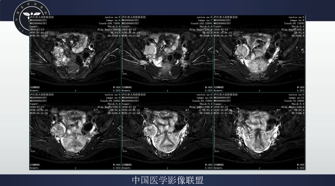 影像PPT - 【病例】卵巢透明细胞癌1例MR影像表现-4