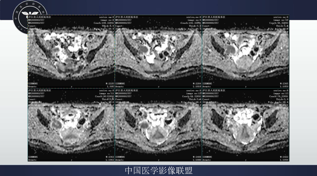 影像PPT - 【病例】卵巢透明细胞癌1例MR影像表现-9
