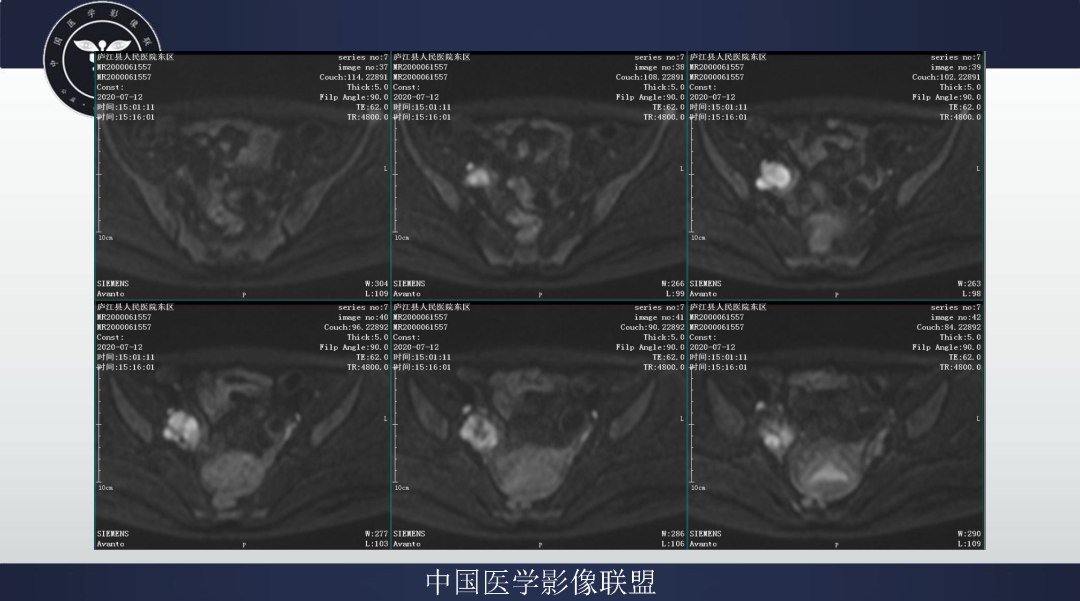 影像PPT - 【病例】卵巢透明细胞癌1例MR影像表现-8