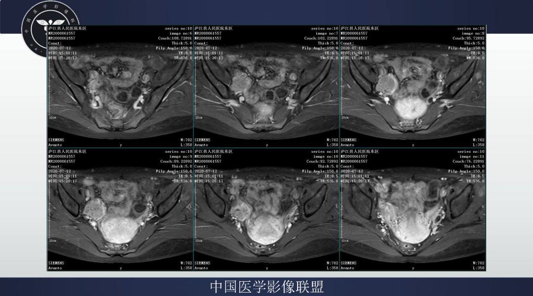 影像PPT - 【病例】卵巢透明细胞癌1例MR影像表现-10
