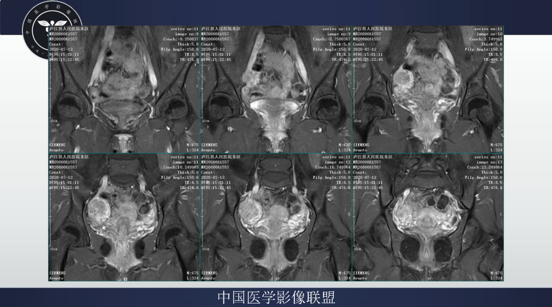 影像PPT - 【病例】卵巢透明细胞癌1例MR影像表现-11