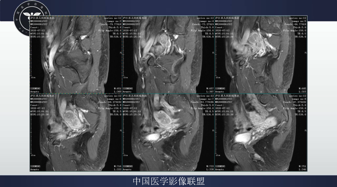 影像PPT - 【病例】卵巢透明细胞癌1例MR影像表现-12