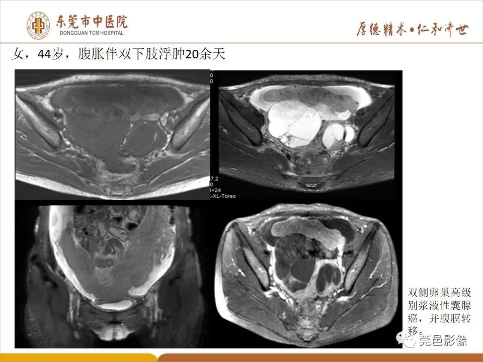 影像PPT - 【病例】卵巢透明细胞癌1例MR影像表现-27