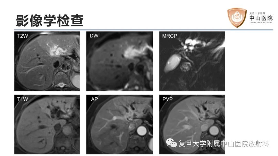 影像PPT - 【病例】肝内胆管细胞癌2例MR影像-3