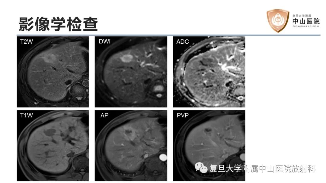 影像PPT - 【病例】肝内胆管细胞癌2例MR影像-5