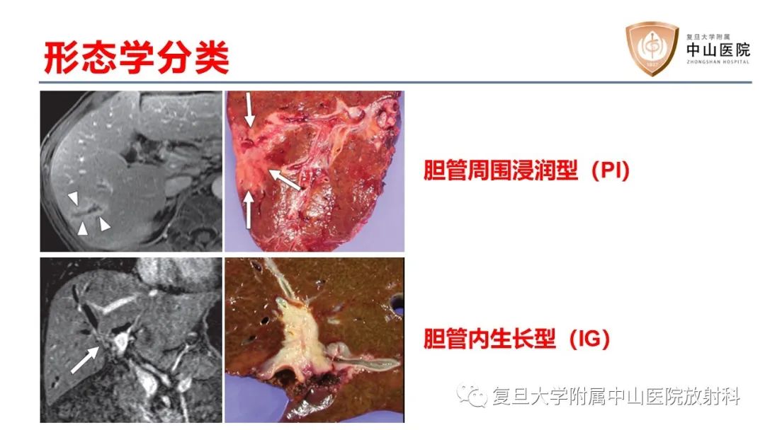 影像PPT - 【病例】肝内胆管细胞癌2例MR影像-13