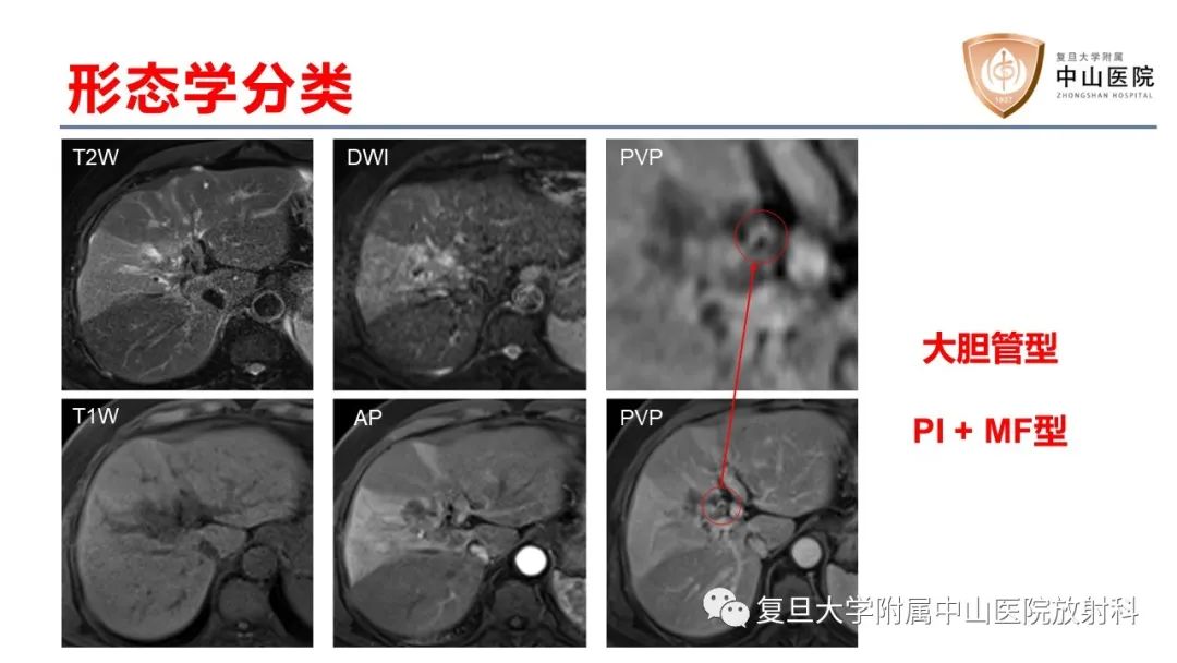 影像PPT - 【病例】肝内胆管细胞癌2例MR影像-14