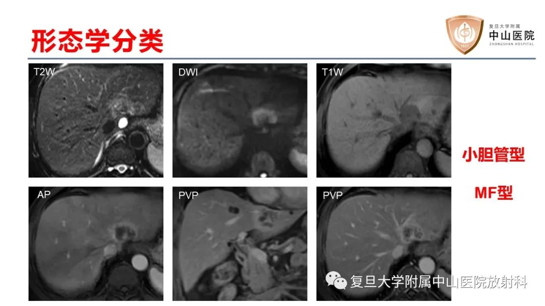 影像PPT - 【病例】肝内胆管细胞癌2例MR影像-16