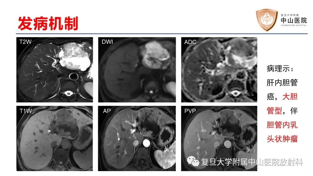 影像PPT - 【病例】肝内胆管细胞癌2例MR影像-21