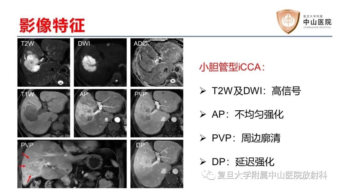 影像PPT - 【病例】肝内胆管细胞癌2例MR影像-23