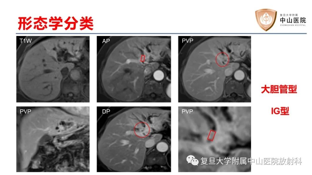 影像PPT - 【病例】肝内胆管细胞癌2例MR影像-15