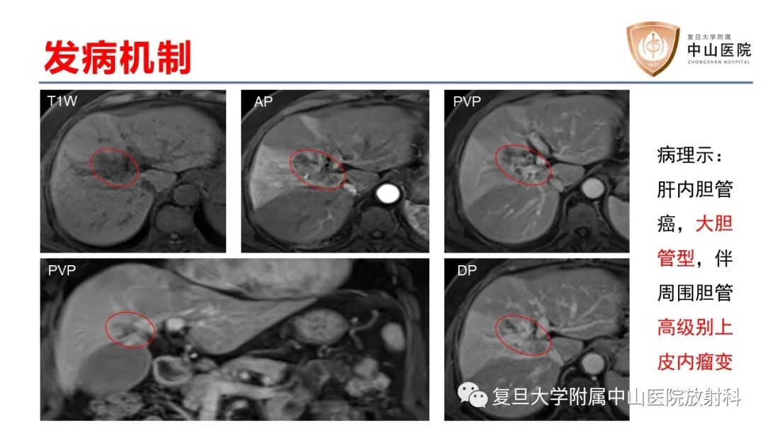 影像PPT - 【病例】肝内胆管细胞癌2例MR影像-20