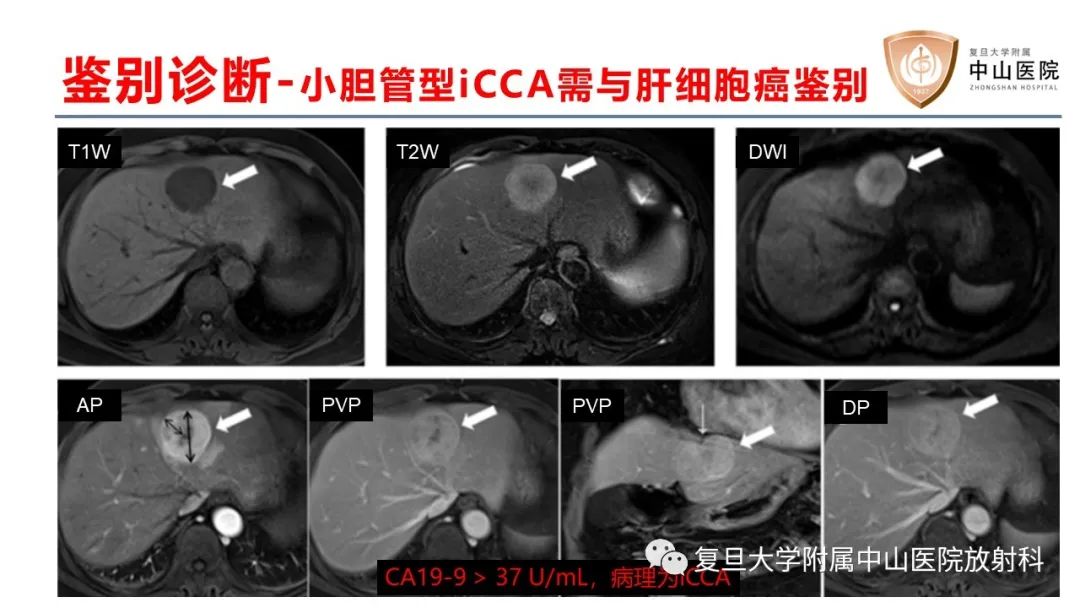 影像PPT - 【病例】肝内胆管细胞癌2例MR影像-27