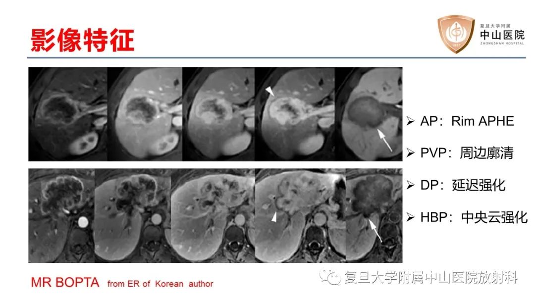 影像PPT - 【病例】肝内胆管细胞癌2例MR影像-26