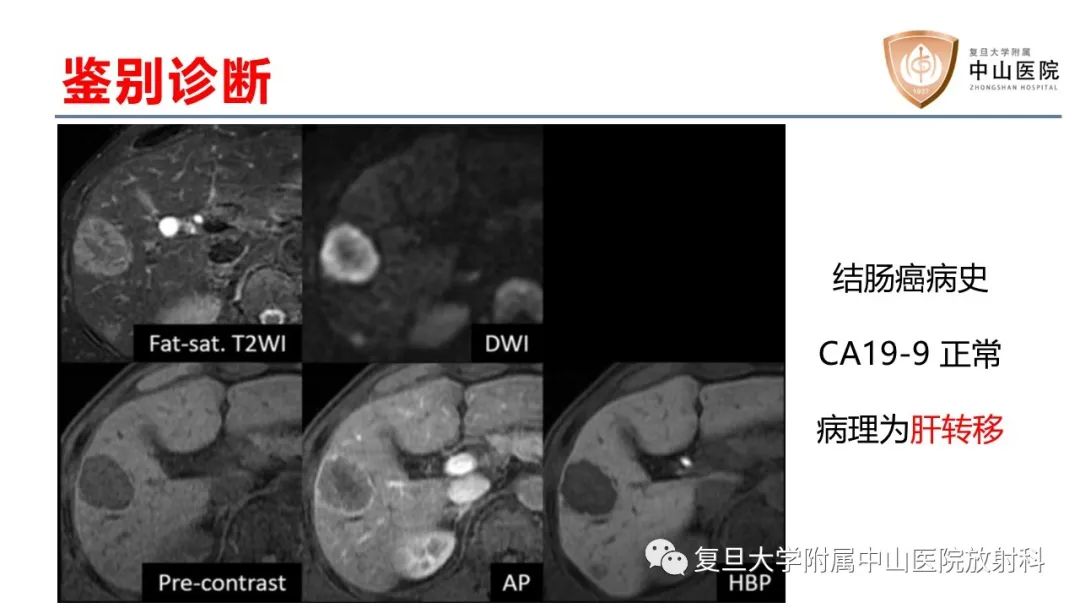 影像PPT - 【病例】肝内胆管细胞癌2例MR影像-28