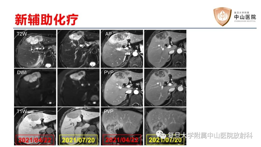 影像PPT - 【病例】肝内胆管细胞癌2例MR影像-33