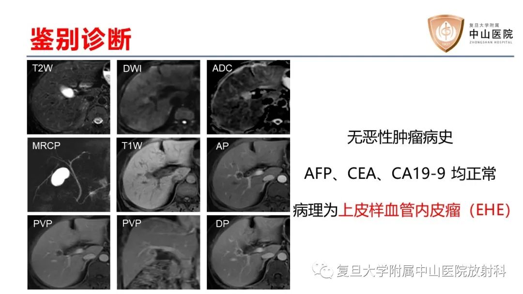 影像PPT - 【病例】肝内胆管细胞癌2例MR影像-30