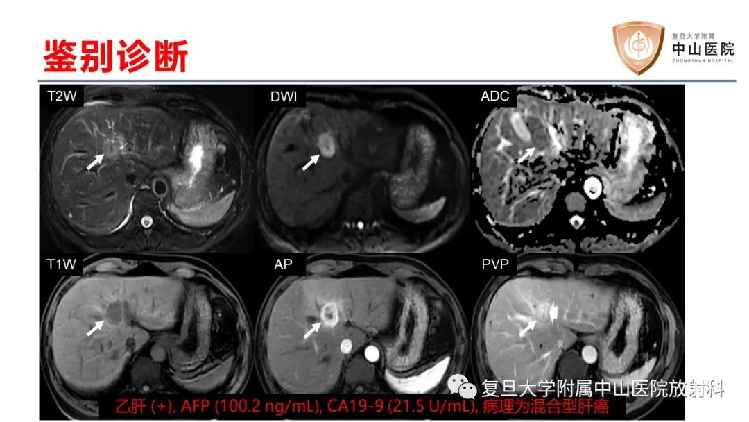 影像PPT - 【病例】肝内胆管细胞癌2例MR影像-29