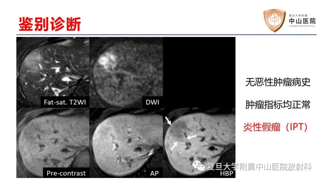 影像PPT - 【病例】肝内胆管细胞癌2例MR影像-31