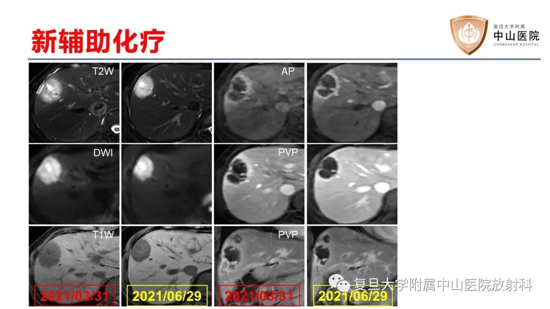 影像PPT - 【病例】肝内胆管细胞癌2例MR影像-34