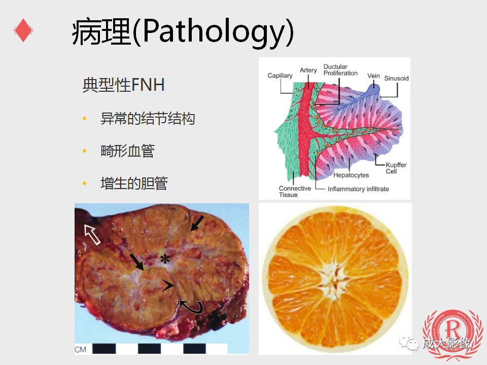 影像PPT - 【PPT】局灶性结节增生的影像表现-7